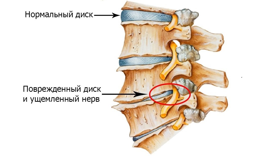 osteohondroz.jpg