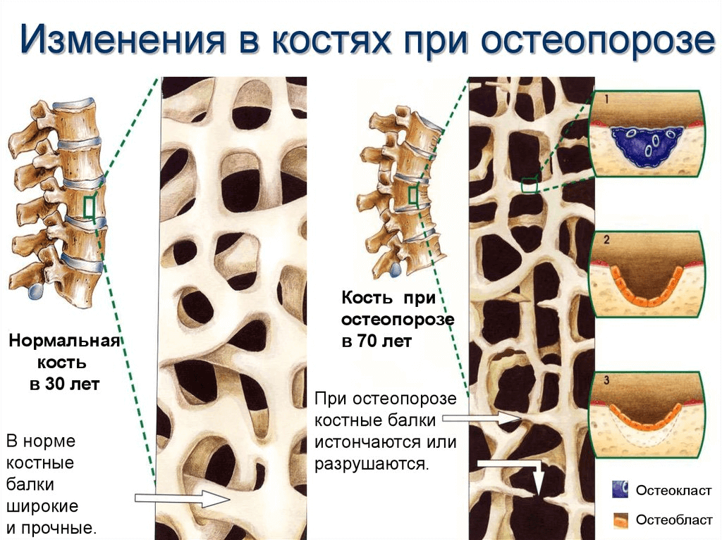 osteoporoz3.png